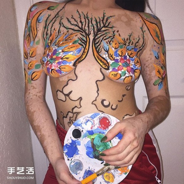 My mark of pride! A girl with vitiligo uses body painting to regain her confidence